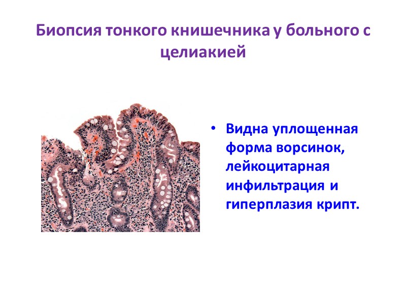 Биопсия тонкого книшечника у больного с целиакией   Видна уплощенная форма ворсинок, лейкоцитарная